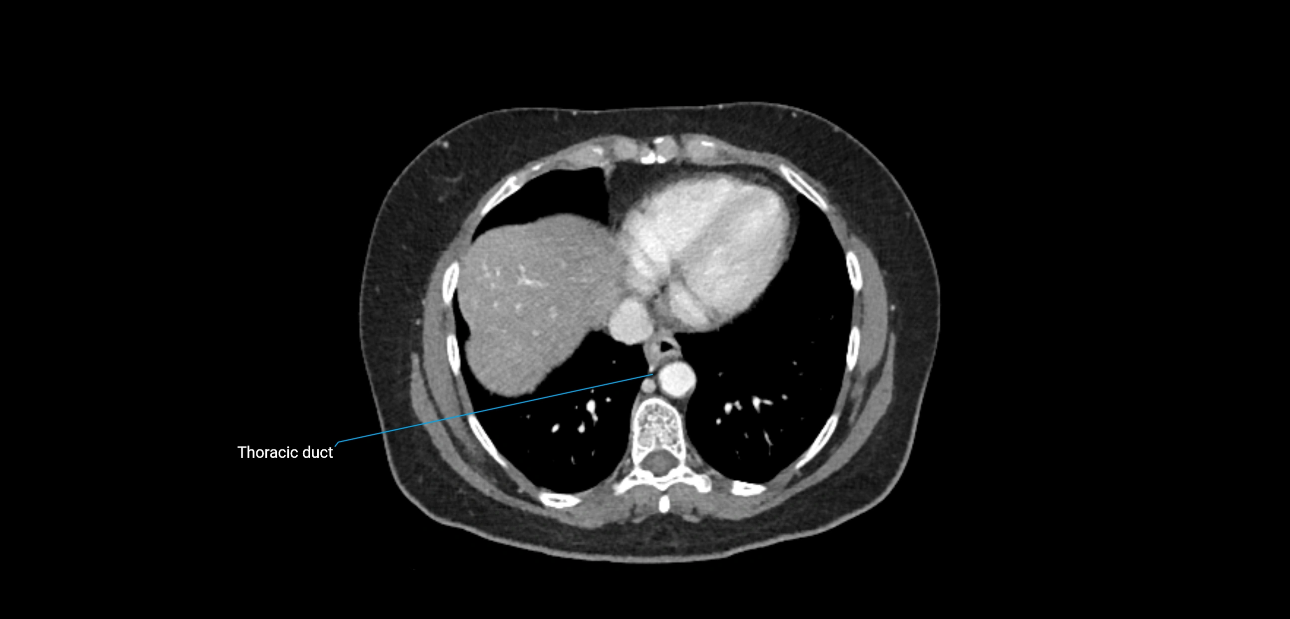 CT ct abdominal lymph nodes  axial cross sectional anatomy  enchanced radiology image -img-00002-00061.webp